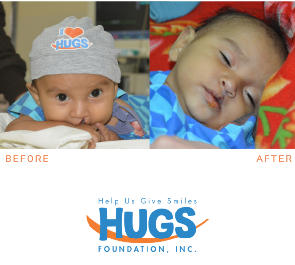 HUGS logo with before and after photos of a child who received treatment